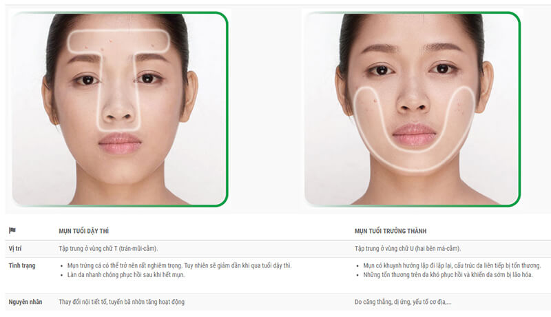 các vấn đề về da - trị mụn ở người trưởng thành