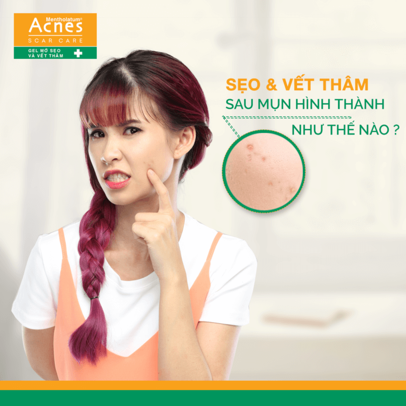 cơ chế hình thành sẹo và vết thâm từ đâu mà có?