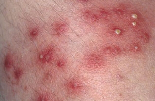 Trị mụn đầu trắng hiệu quả làm thế nào cho đúng cách