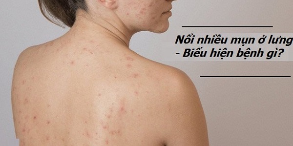 Mụn lưng gây bất tiện trong việc lựa chọn trang phục yêu thích