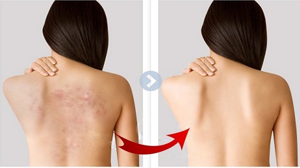 Xà phòng trị mụn Acnes giải quyết vấn đề về mụn trên cơ thể